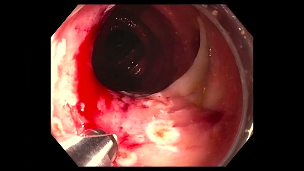 Endorotor Endoscopic Powered Resection By Antonio Rodríguez-D’jesús