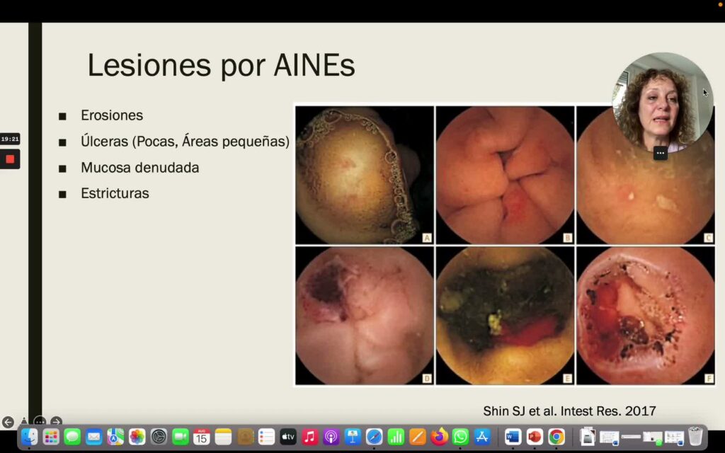 Endoscopía Del Intestino Delgado By Dr. Lucía Fry 3 Endoscopía Del Intestino Delgado By Dr. Lucía Fry