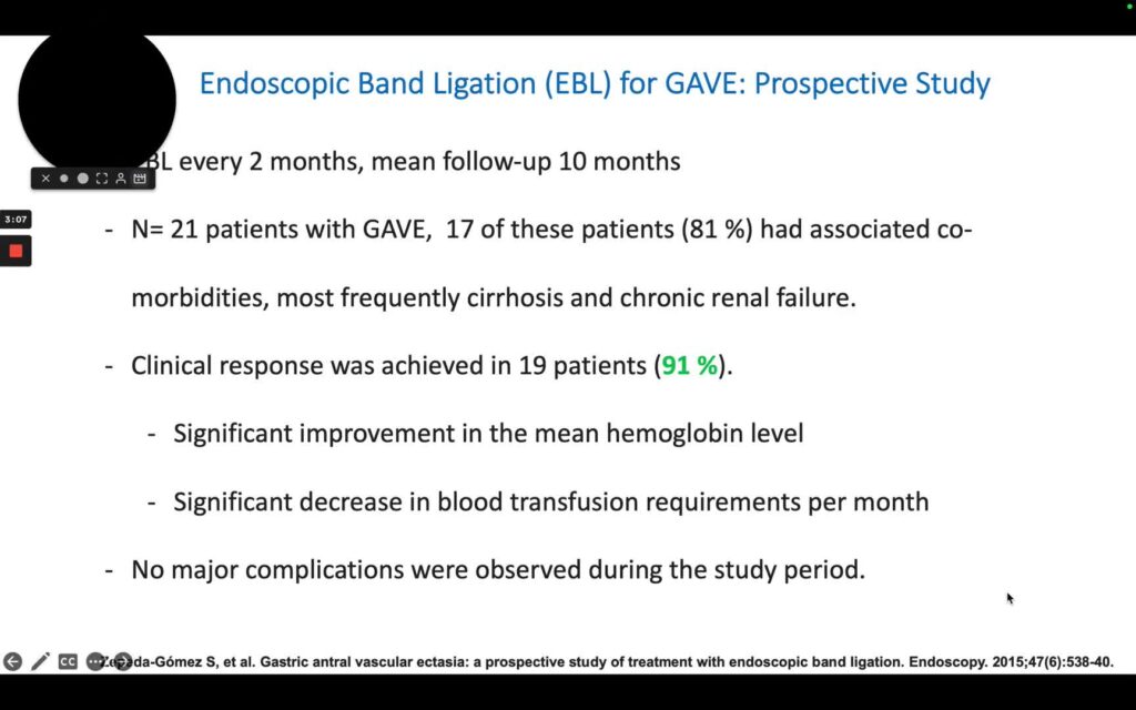 Endoscopic Band Ligation for Gastric Antral Vascular Extasia (GAVE) or “Watermelon Stomach”