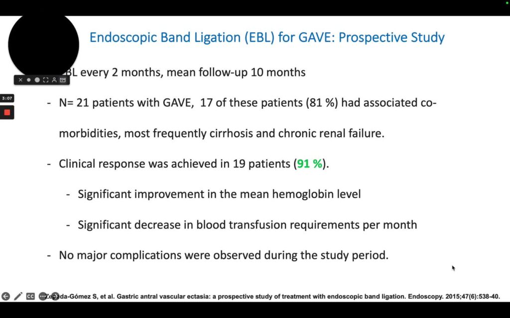 Endoscopic Band Ligation For Gave