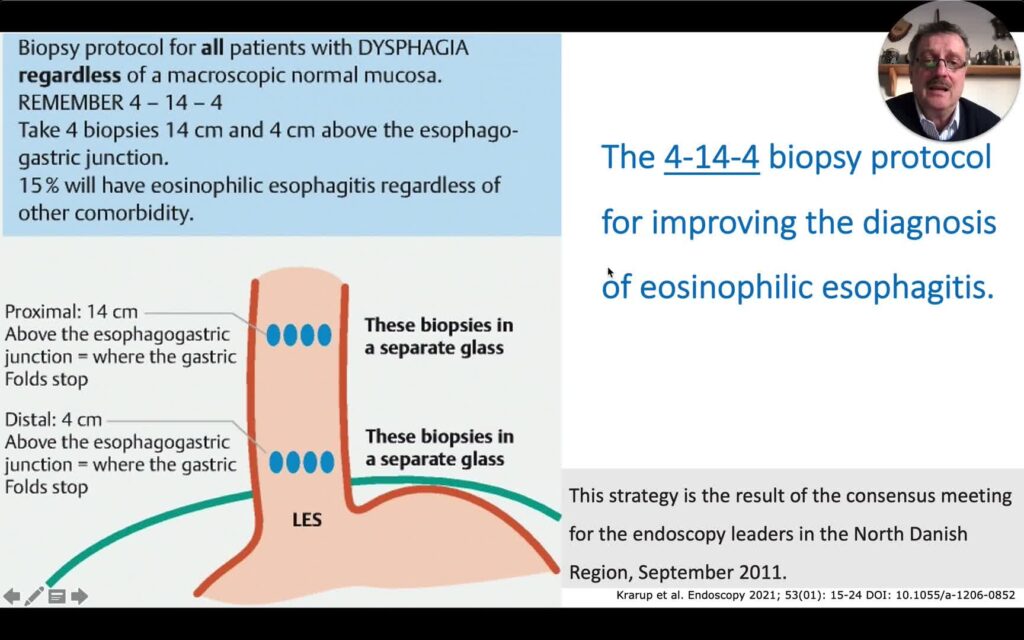 Endoscopic Biopsies In Eosinophilic Esophagitis
