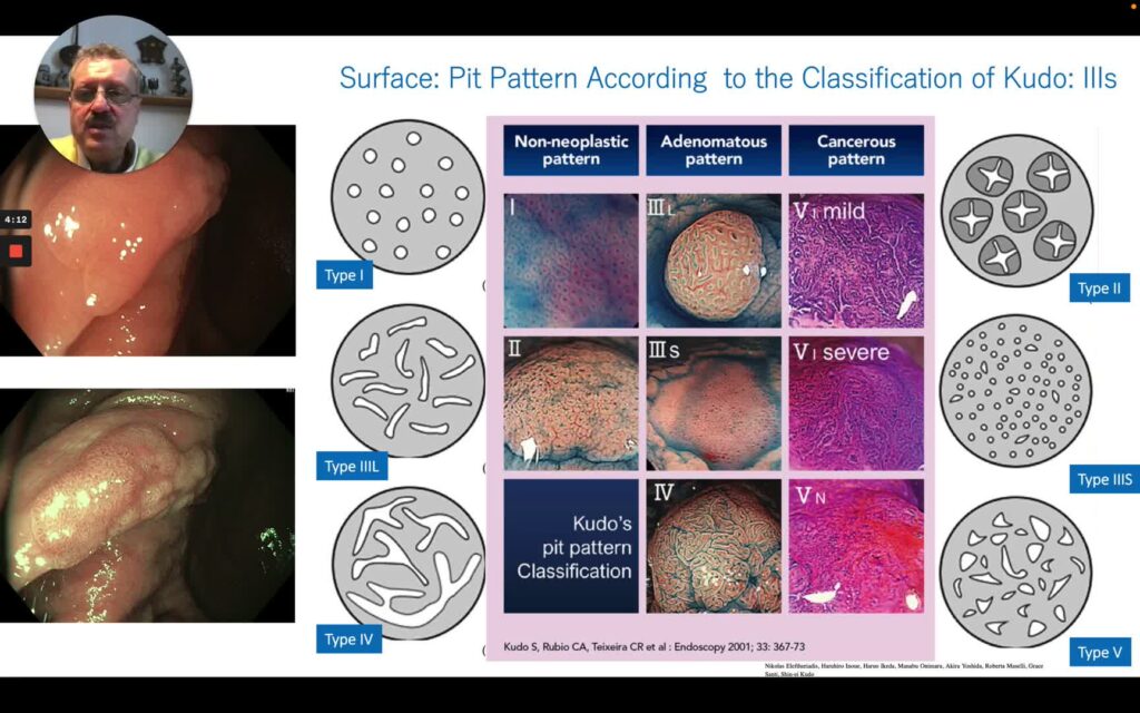 Endoscopic Characterisation of Non-Polypoid Lesion in the Cecum