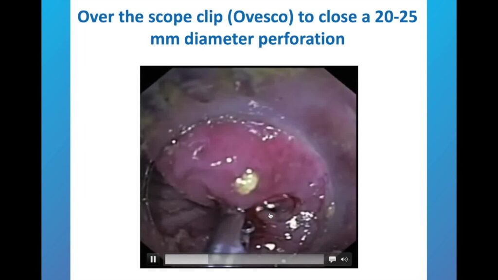 Endoscopic Closure of Complex Gastrointestinal Leaks