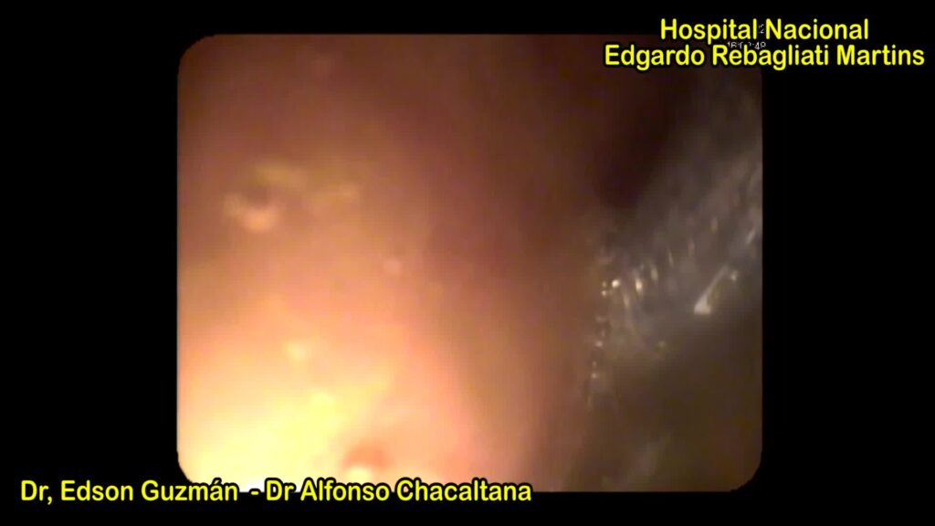 Eus-Guided Drainage Of Walled-Off Necrosis With Lumen Apposing Metal Stent (Hot Spaxus)