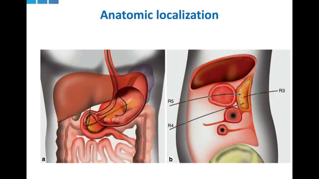 Endoscopic Drainage Of Pancreatic Pseudocysts And Necrosis – An Outline