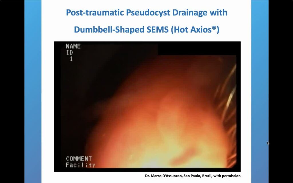 Endoscopic Drainage Of Pos-Traumatic Pseudocyst Using Dumbbell-Shape Sems By Marco Assunção