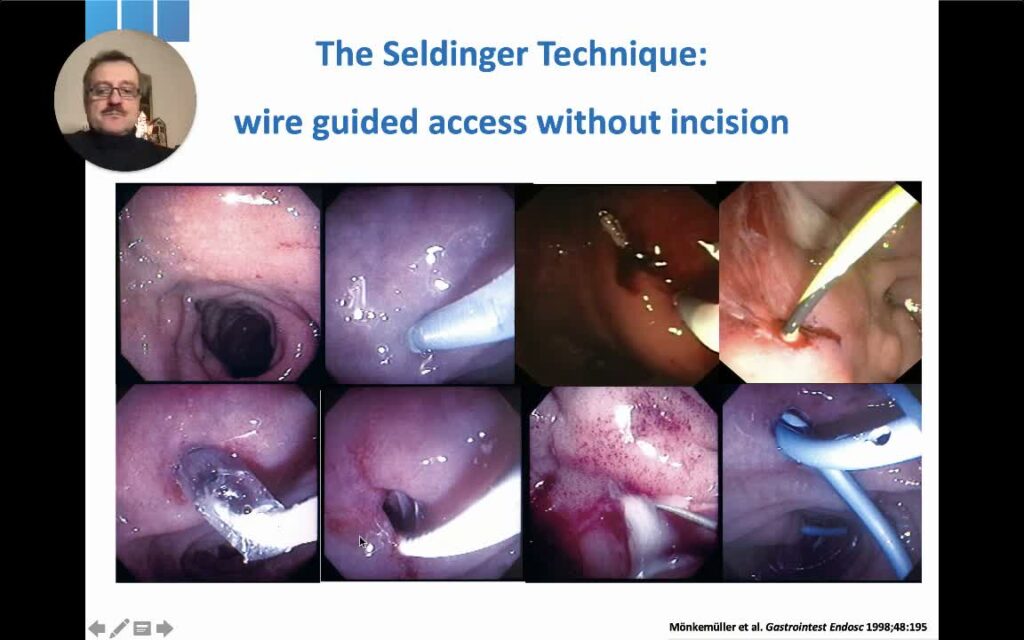 Endoscopic Drainage Of Pseudocysts Using The Seldinger Technique