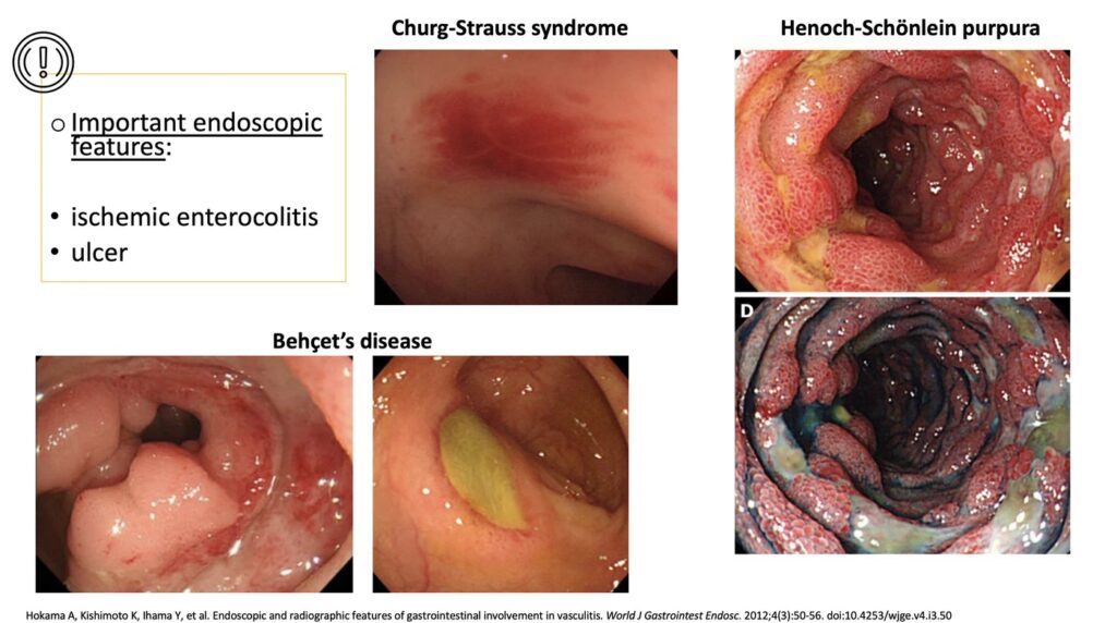 Endoscopic Eatures Of Gi Involvement In Vasculitis By Katarzyna Monika Pawlak