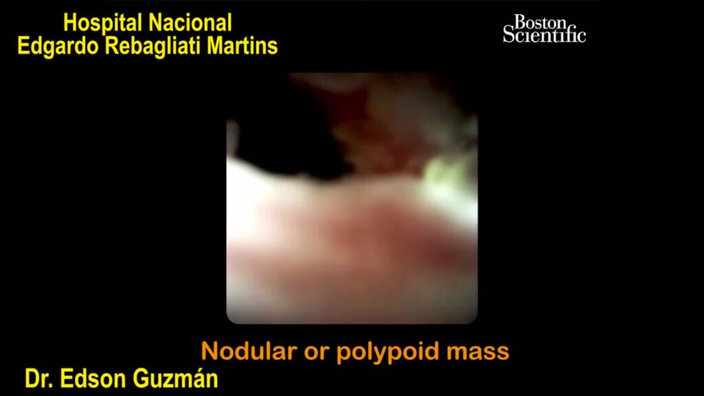 Endoscopic Features Of The Hilar Cholangiocarcinoma During Cholangioscopy By Dr. Edson Guzmán Calderón