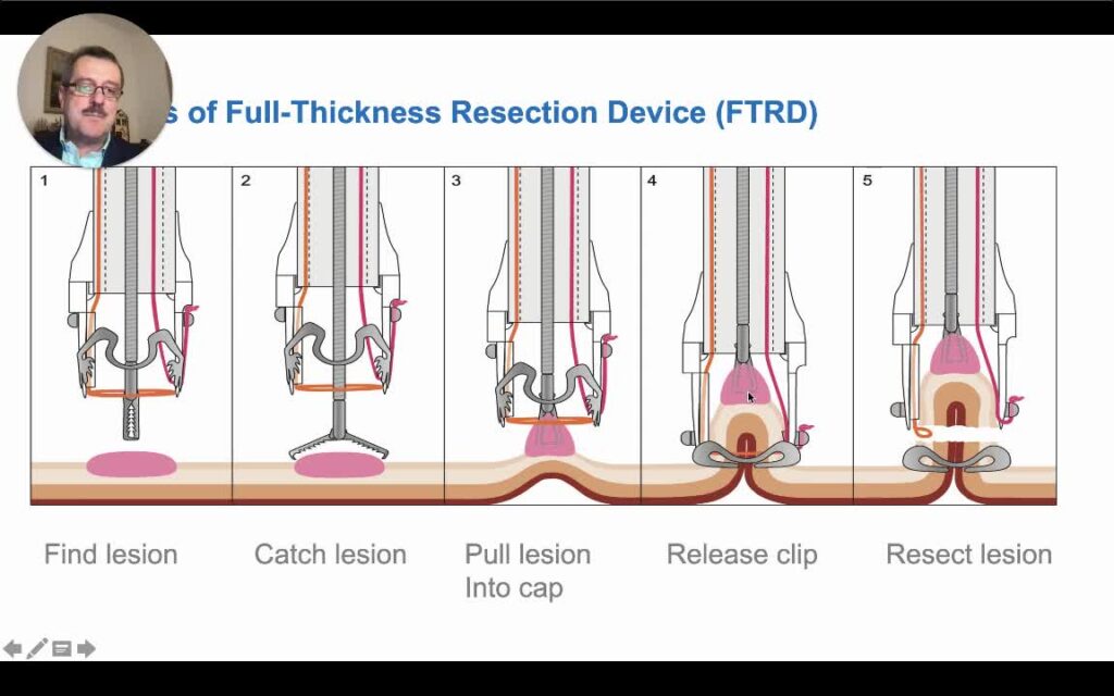 Endoscopic Full Thickness Resection (Eftr) For Duodenal Lesions 2 Endoscopic Full Thickness Resection (Eftr) For Duodenal Lesions