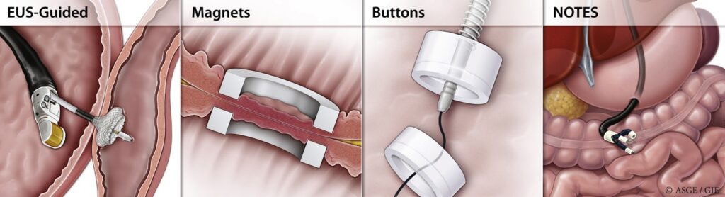 Endoscopic Gi Anastomoses Review 7 Endoscopic Gi Anastomoses Review