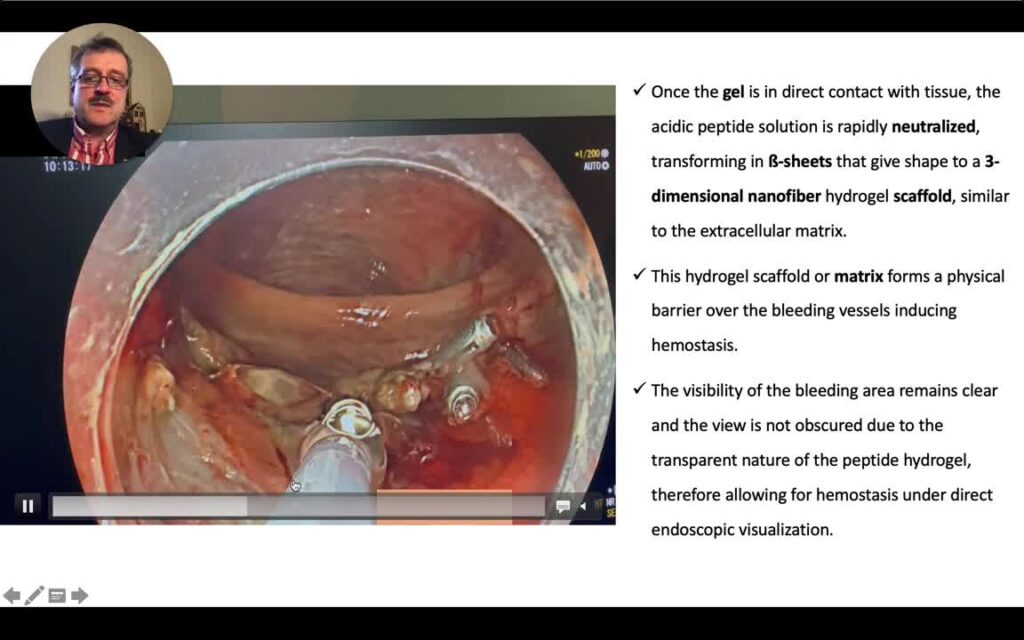 Endoscopic Hemostasis With Gel (E.g. Purastat) 9 Endoscopic Hemostasis With Gel (E.g. Purastat)