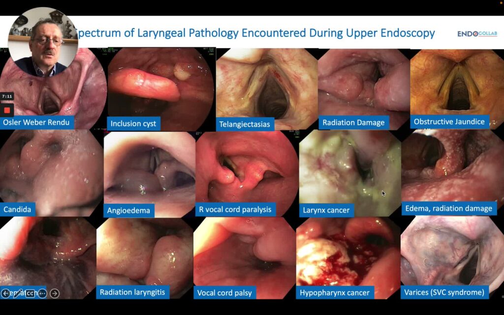 Endoscopic Inspection Of The Hypopharynx And Larynx 8 Endoscopic Inspection Of The Hypopharynx And Larynx