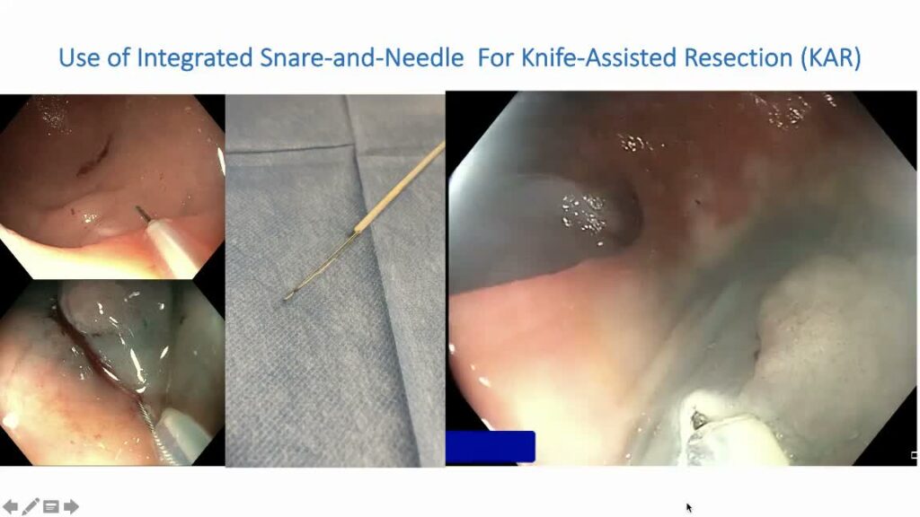 Endoscopic Knife-Assisted (Kar) Resection Using The Two-In-One Needle Snare Device