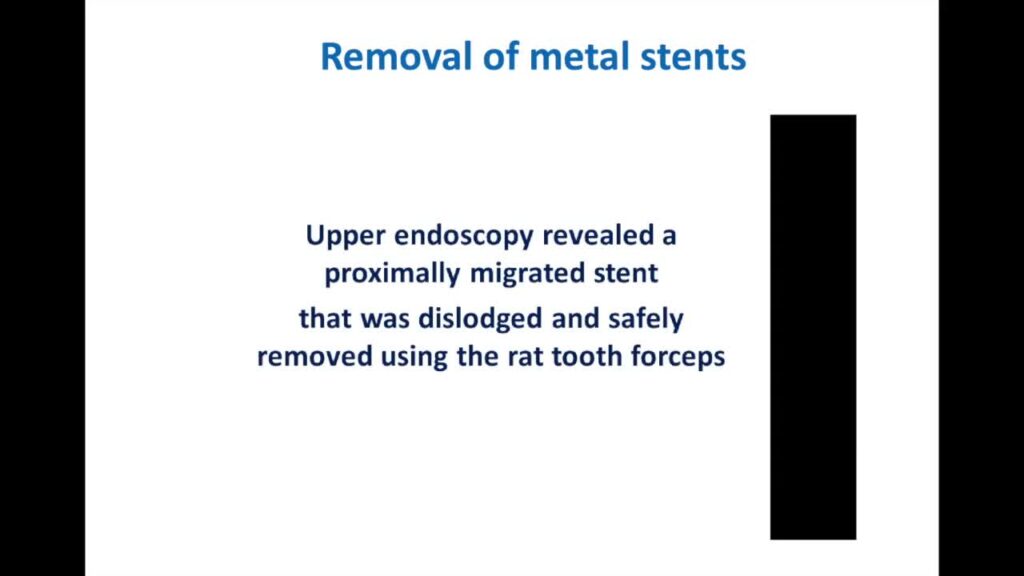 Endoscopic Management Of Foreign Bodies (Part 2)