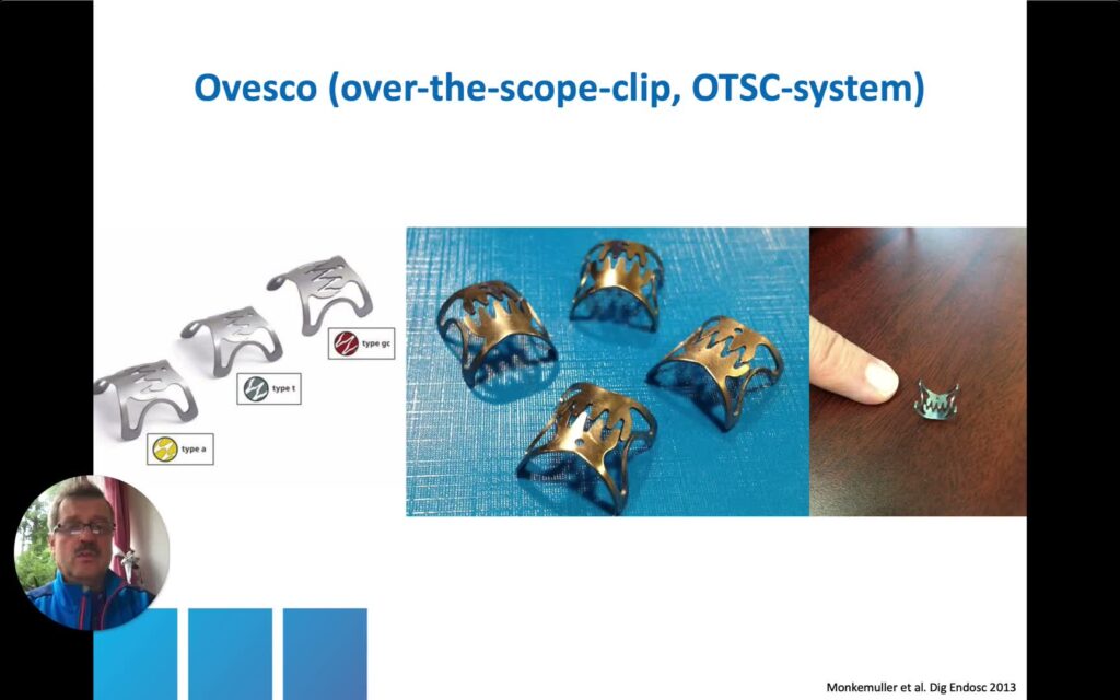 Endoscopic Management Of Post-Bariatric Surgery Complications (Part I)