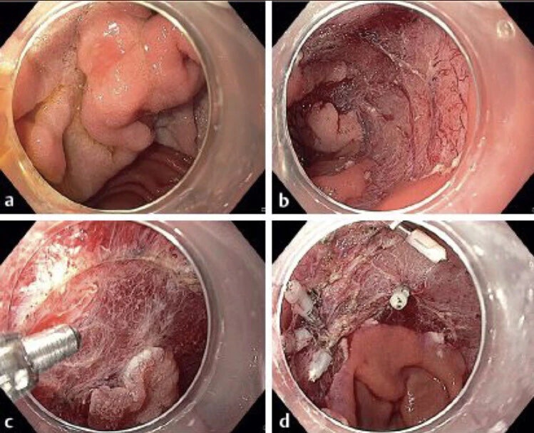 Endoscopic Mucosal Resection Procedure For A Nonampullary
