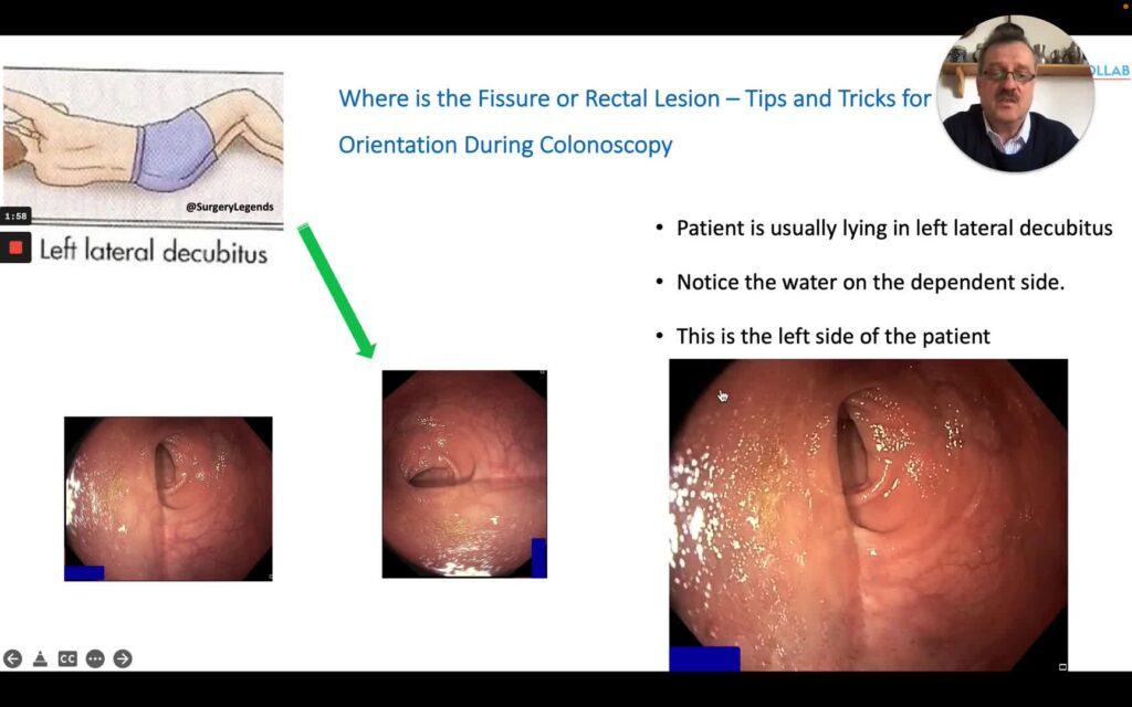 Endoscopic Orientation in the Rectum