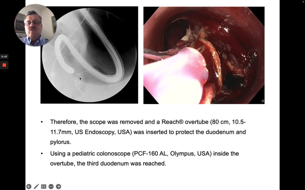 Endoscopic Removal Of A Distally Migrated Duodeno-Jejunal Bypass Sleeve (Endobarrier)