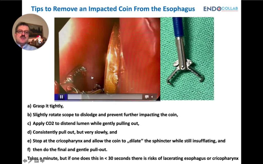Endoscopic Removal of Coins From the Esophagus