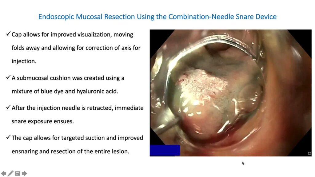 Endoscopic Resection of Duodenal Adenoma Using Cap-Assisted Combination Needle Snare Device