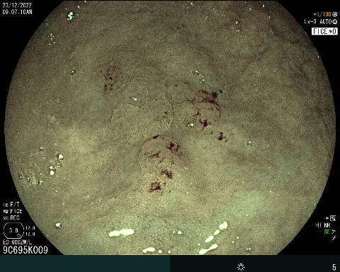 Endoscopic Resection Of Flat Non-Polypoid Cecal Lesion By Dr Guido Llontop Cuzquen