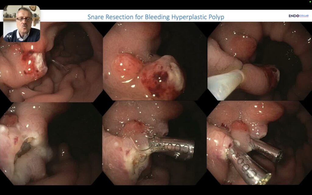 Endoscopic Resection Techniques for Stomach Lesions