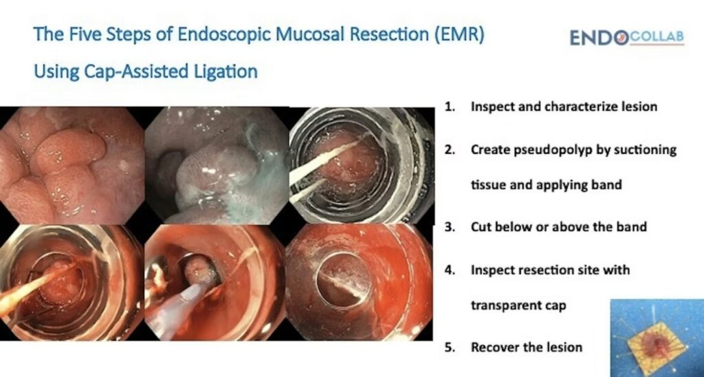 Endoscopic Resection Using Band Ligation And Cap 7 Endoscopic Resection Using Band Ligation And Cap