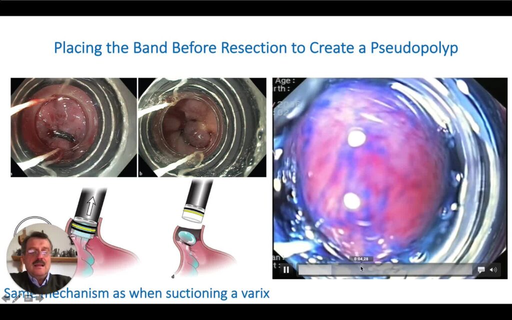 Endoscopic Resection Using Cap-Assisted Ligation Devices