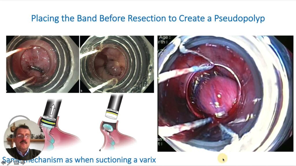 Endoscopic Resection Using Cap-Ligation Technique