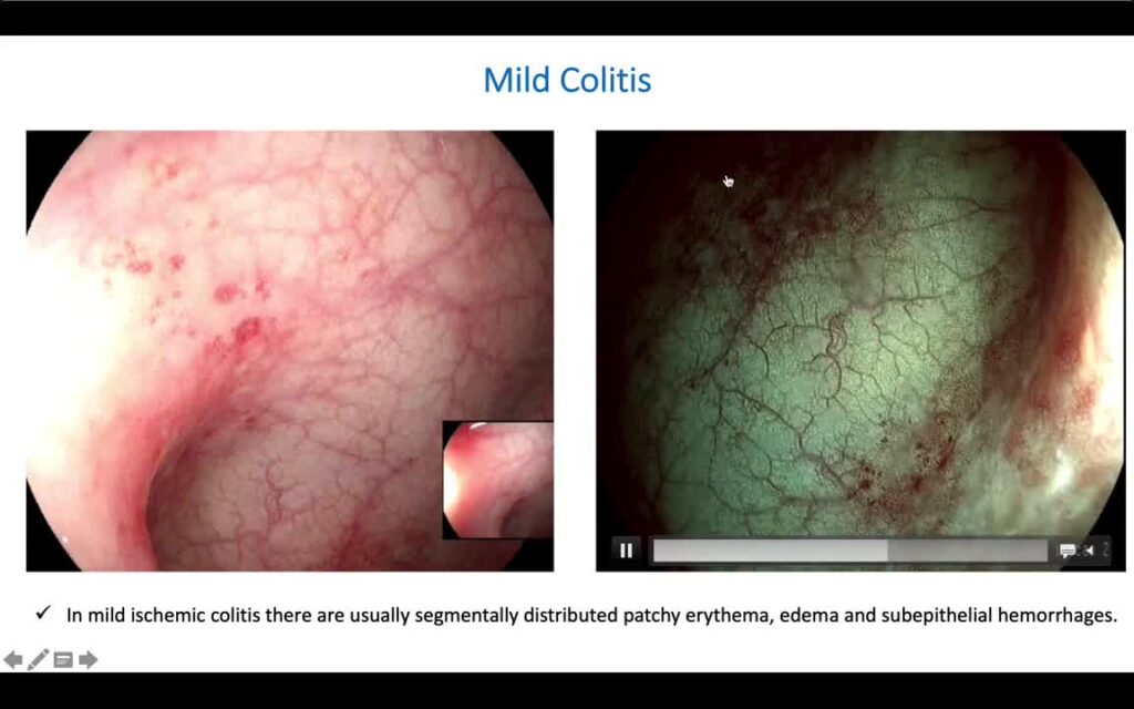 Endoscopic Spectrum of Ischemic Colitis