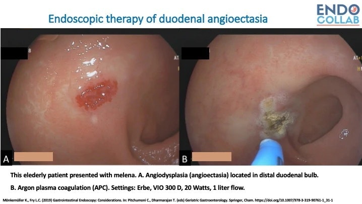 Endoscopic Therapy Of Duodenal Avm (Angioectasia)