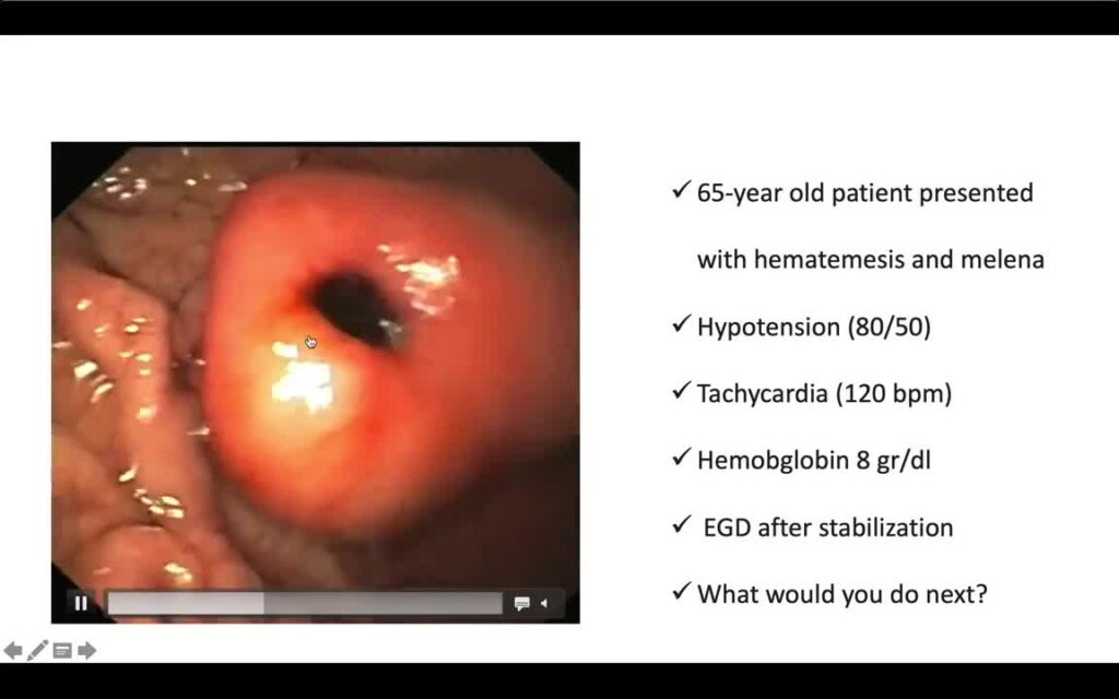 Bleeding Submucosal Stomach Tumor 10 Bleeding Submucosal Stomach Tumor