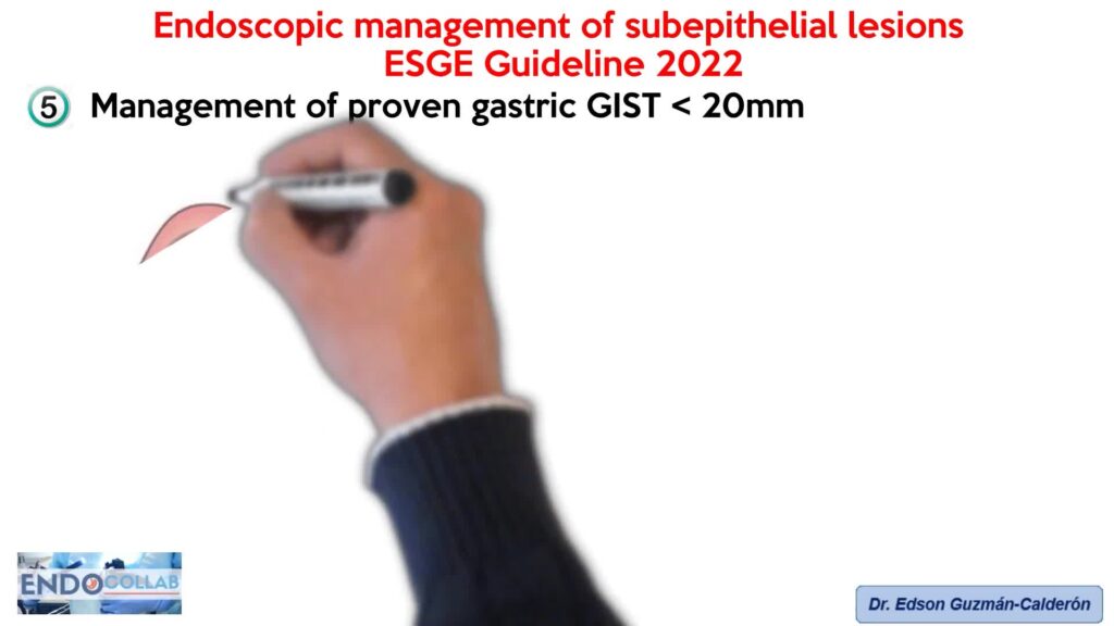 Endoscopic Management Of Subepithelial Lesions &Amp; Neuroendocrine Neoplasms: Esge Guideline 2022 By Dr Edson Guzman Calderon