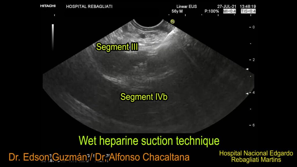 Eus-Guided Needle Biopsy Of The Liver