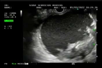 Endoscopic Ultrasound-Guided Drainage With A Double-Cup Stent