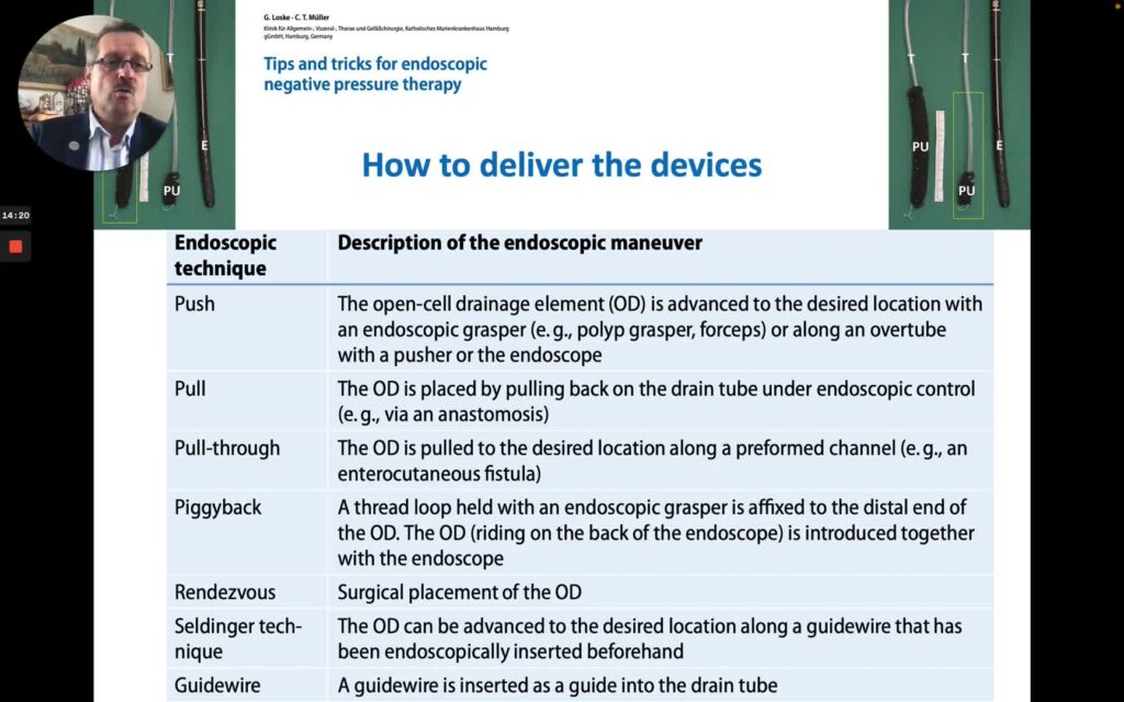 Endoscopic Vacuum Therapy – How To Place