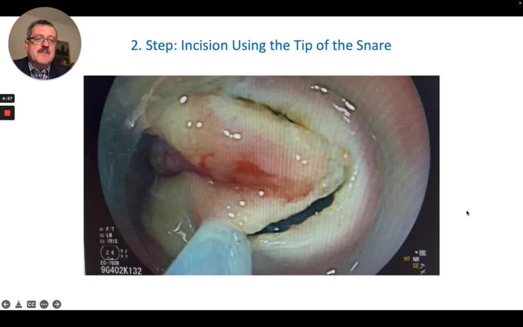 Snare Tip Assisted ESD EMR