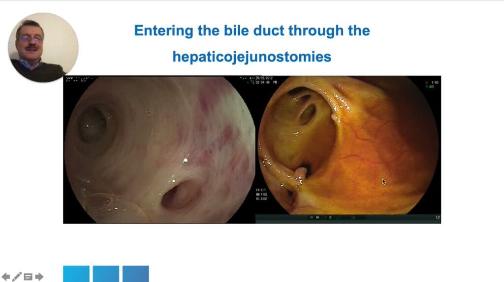 Enteroscopía En Pacientes Con Anatomía Quirúrgicamente Alterada Del Tracto Gastrointestinal Superior 8 Enteroscopía En Pacientes Con Anatomía Quirúrgicamente Alterada Del Tracto Gastrointestinal Superior