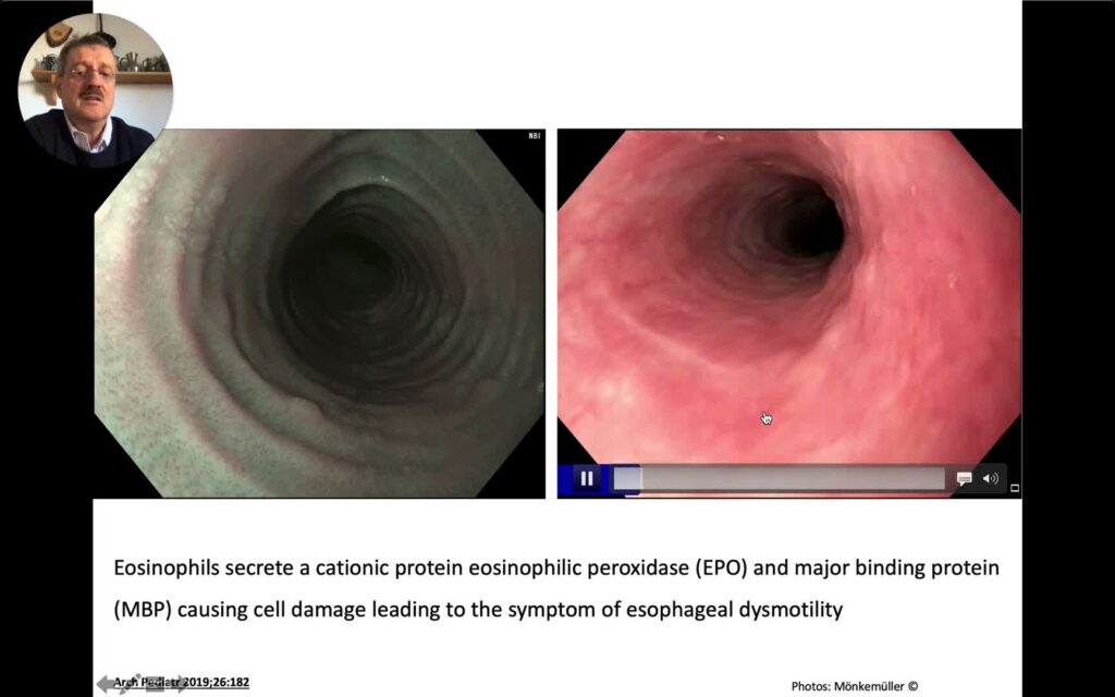 Eosinophilic Esophagitis – A Focus On Its Endoscopic Diagnosis