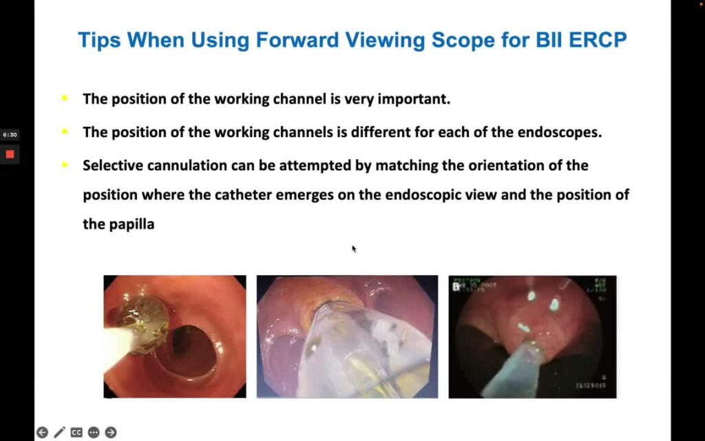 Ercp And Sphincterotomy In Billroth Ii Anatomy 5 Ercp And Sphincterotomy In Billroth Ii Anatomy