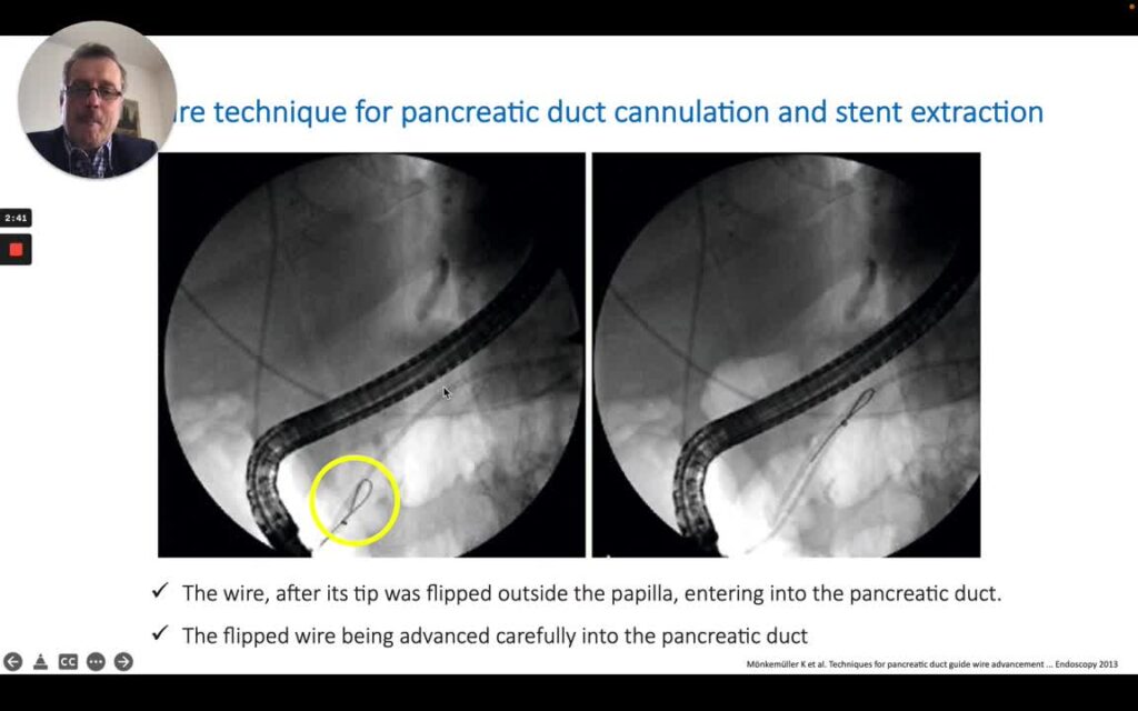 Ercp - Cannulation Tips: The U-Wire Or Flipped Wire Technique 9 Ercp – Cannulation Tips: The U-Wire Or Flipped Wire Technique