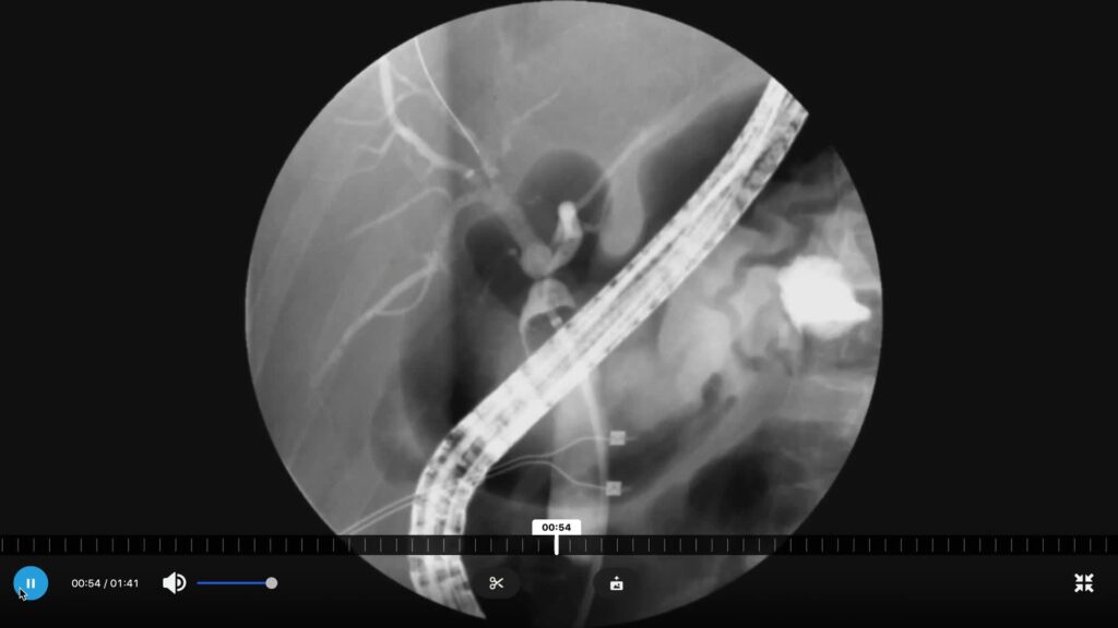 Ercp – Complex Post Liver Transplant Bile Duct Stricture Managed With Soehendra Stent Retriever