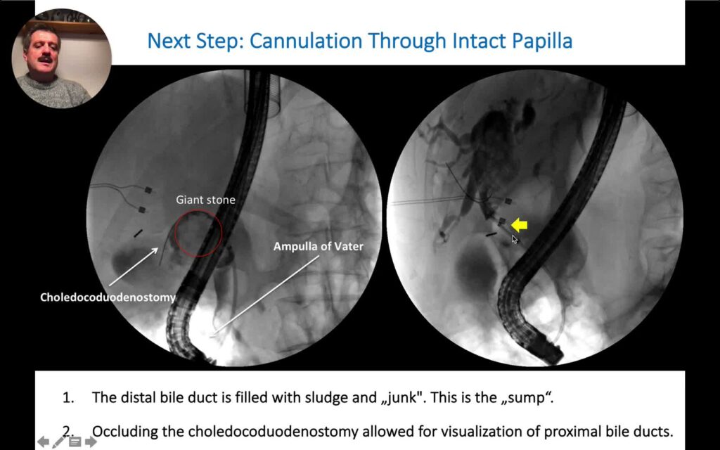 Ercp Complex Stone Cases: The Sump Syndrome