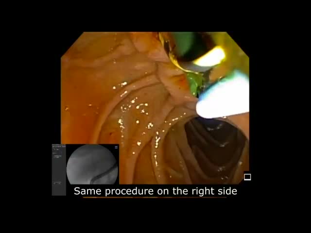 Ercp – Double Stent-Over-The-Wire Removal And Replacement In Patient With Psc By Dr. Rafael Bernal Méndez