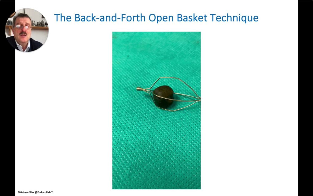 Ercp Essential Tips For Stone Extraction Using Basket Ii 1 Ercp Essential Tips For Stone Extraction Using Basket Ii