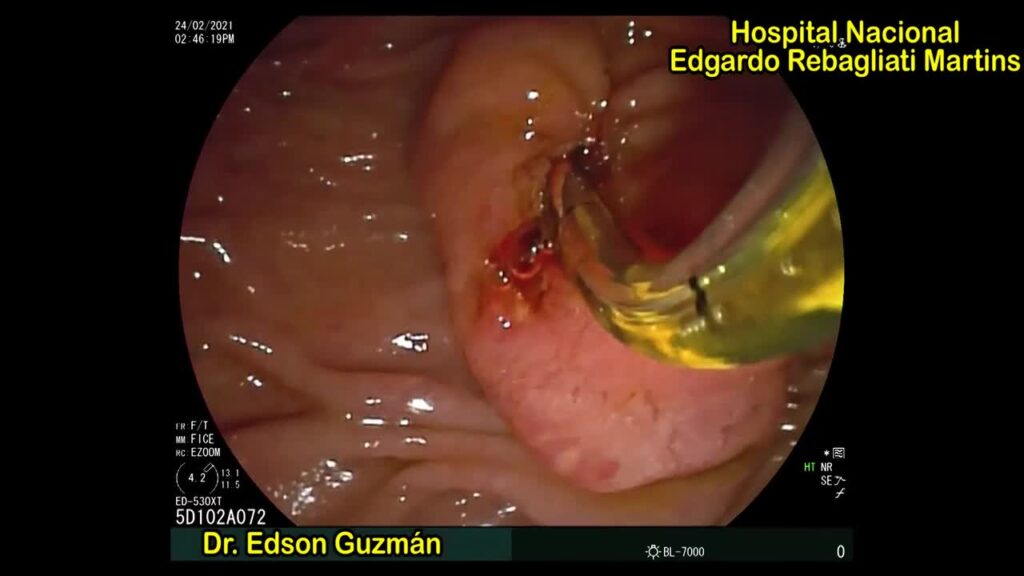 Ercp – Extraction Of Proximally Migrated Plastic Stent By Dr Edson Guzman Calderon