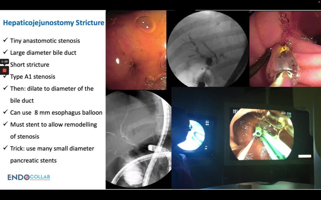 Ercp – Multi-Stenting In The Setting Of Hepaticojejunostomy Anastomosis