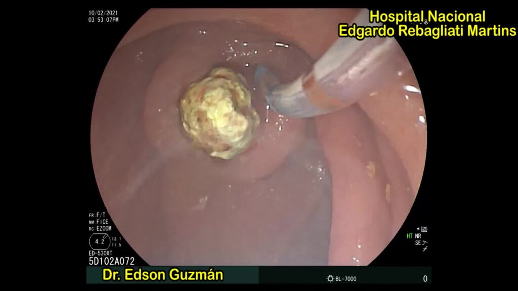 Ercp -Precut Fistulotoy By Dr Edson Guzmán Calderón
