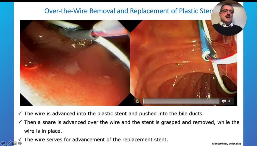 Ercp – Removing And Replacing Stent Over-The-Wire